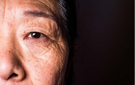 Bệnh thoái hóa hoàng điểm tuổi già